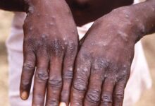 Variole du singe : la prochaine menace sanitaire variole du singe mains