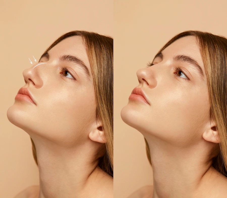 Qu'est-ce qu'une rhinoplastie ultrasonique ? rhinoplasty avant apres operation