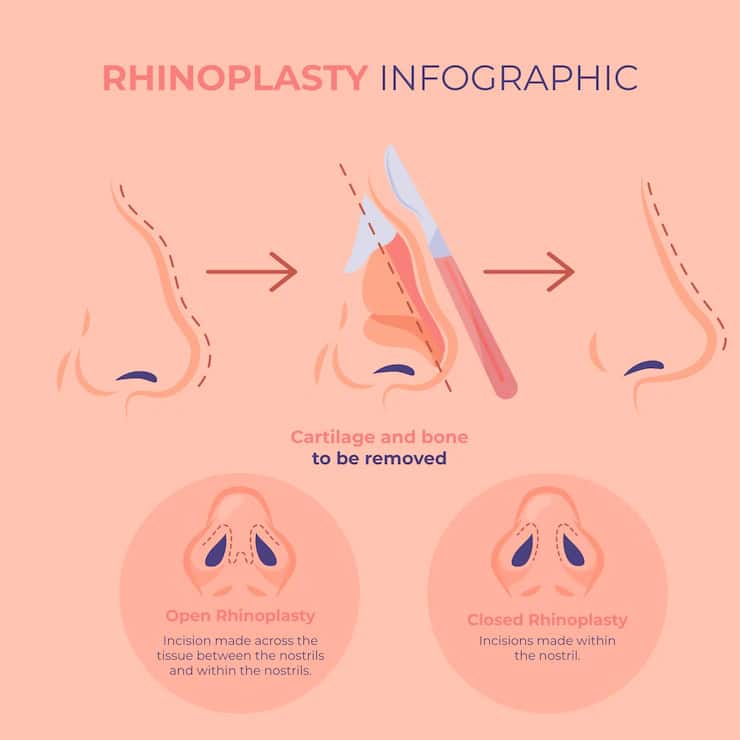 Qu'est-ce qu'une rhinoplastie ultrasonique ? rhinoplasty infography