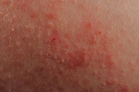 dermatite eczéma texture de la peau humaine malade
