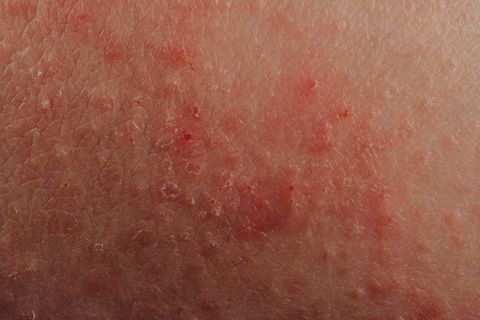 Eczéma mammaire : symptômes, traitement et causes - Okibata