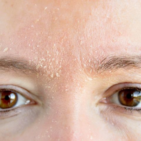 femme présentant des symptômes de dermatite atopique sur le front et les sourcils