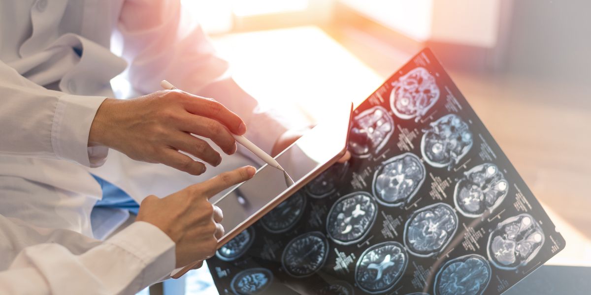 Les 4 types de sclérose en plaques (SEP) : comprendre les symptômes digital x ray of brain with team radiologist doctor royalty free image 1664989041