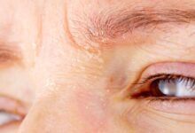 Eczéma visage : Symptômes, causes, traitement et prévention woman with atopic dermatitis royalty free image 1665524510