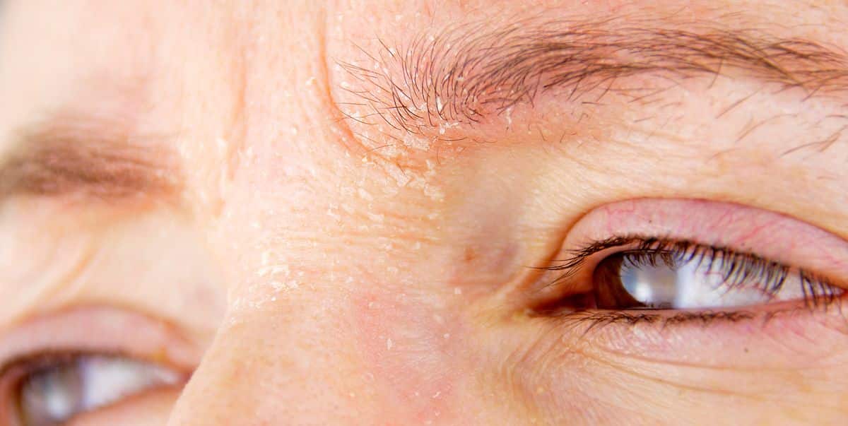 Eczéma visage : Symptômes, causes, traitement et prévention woman with atopic dermatitis royalty free image 1665524510