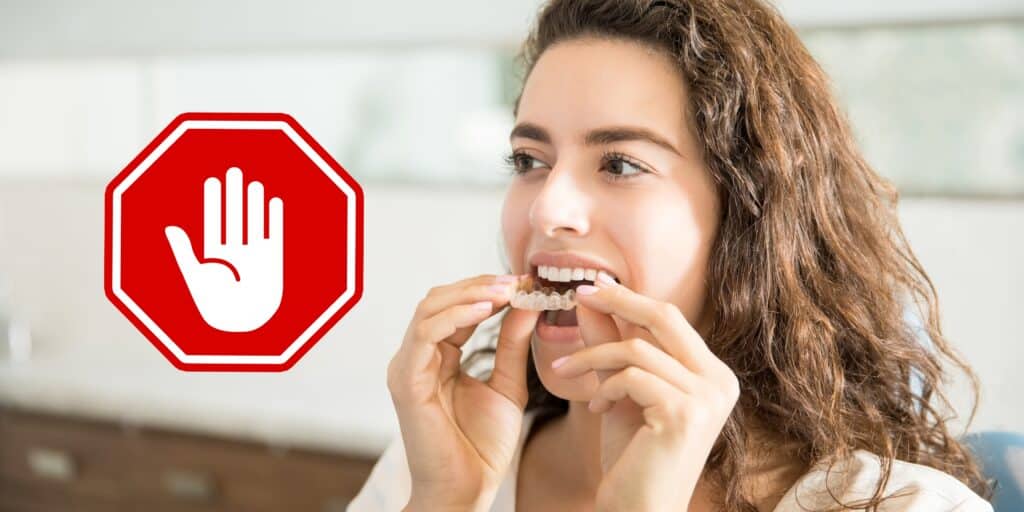 Dangers de la vente en ligne d'aligneurs dentaires : ce que vous devez savoir aligneur dentaire installation