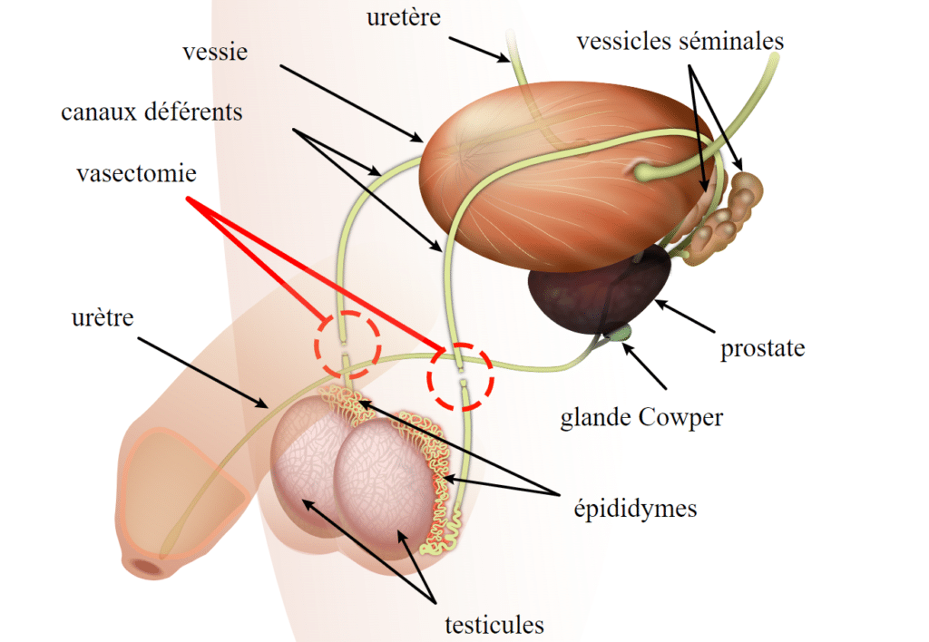 La Vasectomie en France : Un engouement sans précédent vasectomie