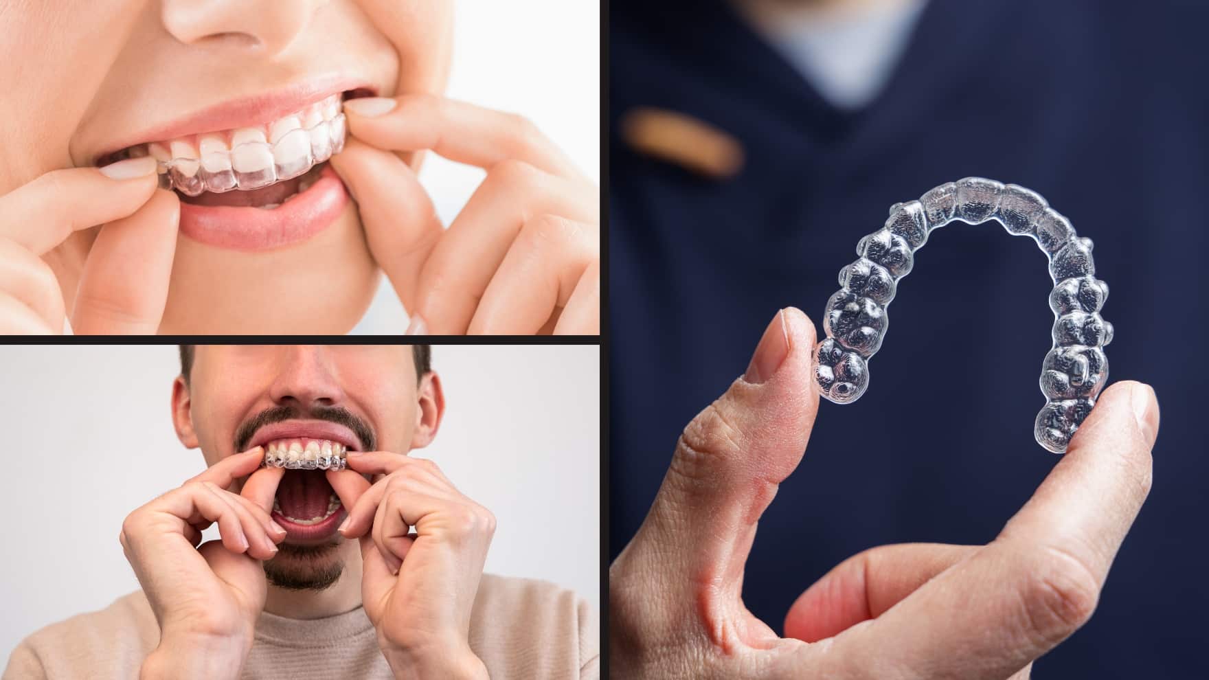 Aligneurs dentaires : Une révolution pour votre sourire aligneur dentaire transparent okibata